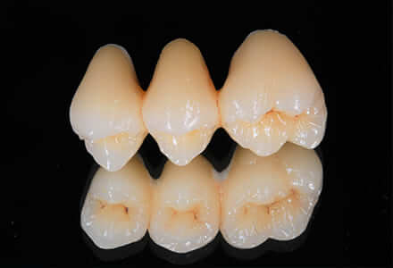 銀歯の下は虫歯になりやすい…